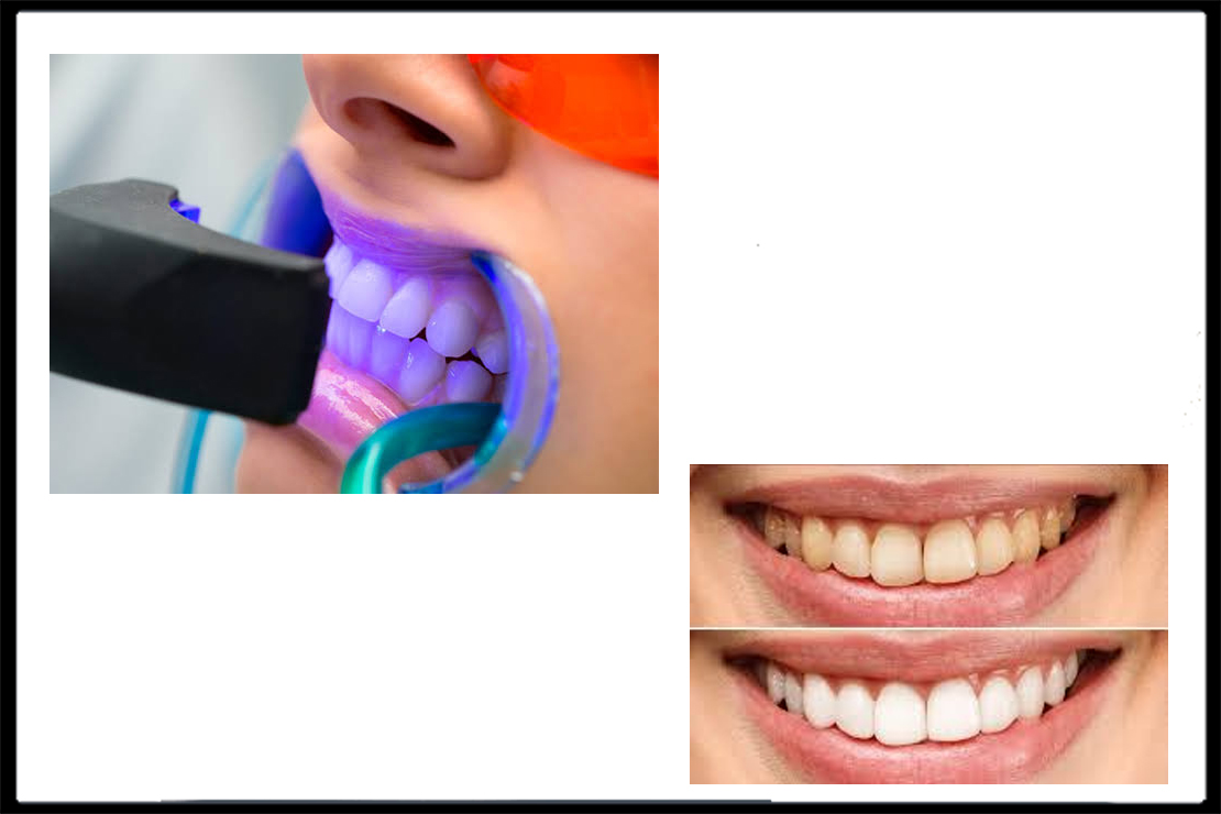 TEETH WHITENING