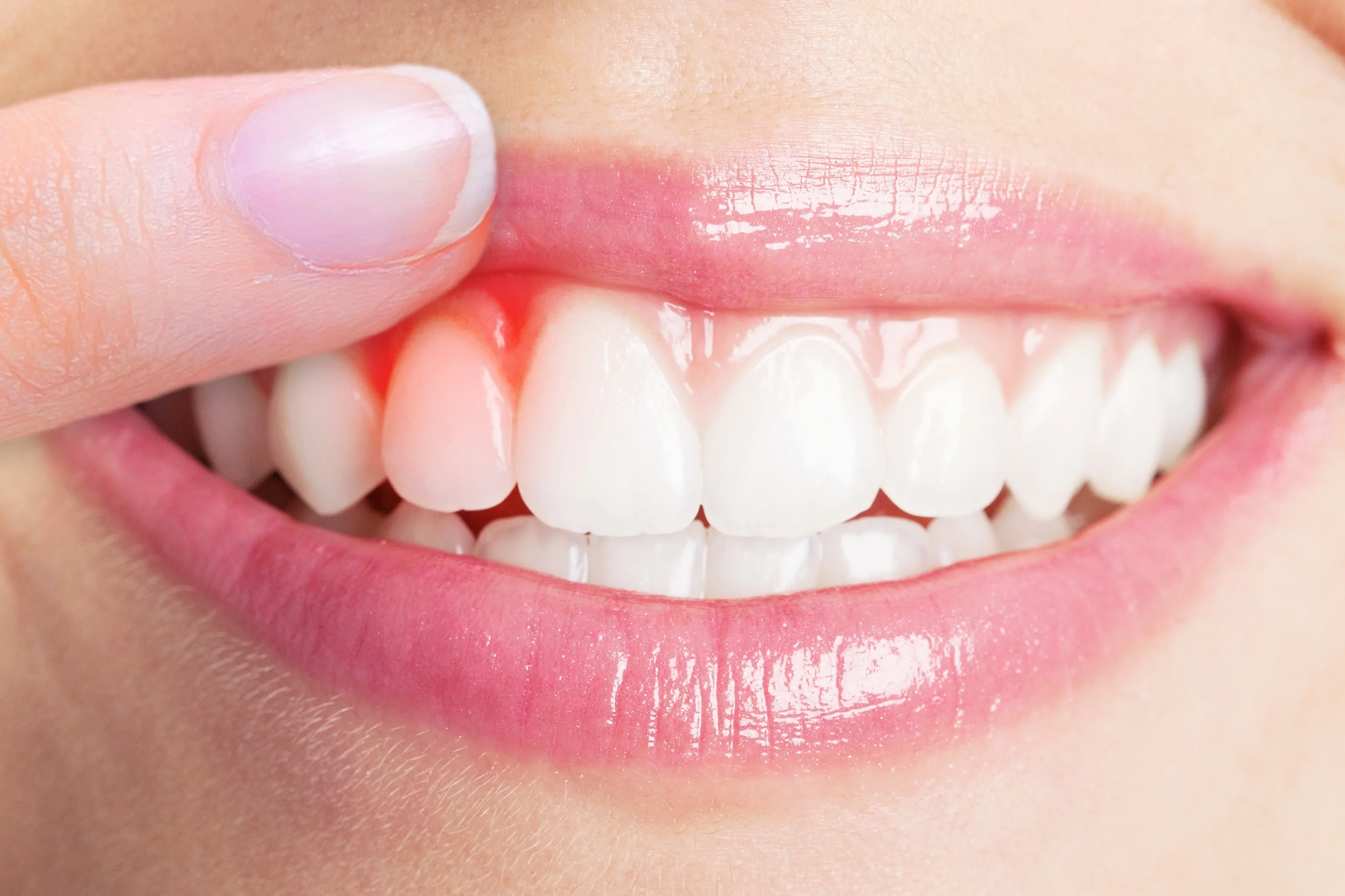 GUM SURGERY