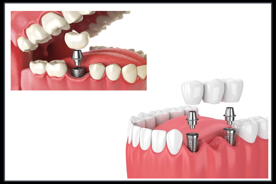 DENTAL IMPLANT