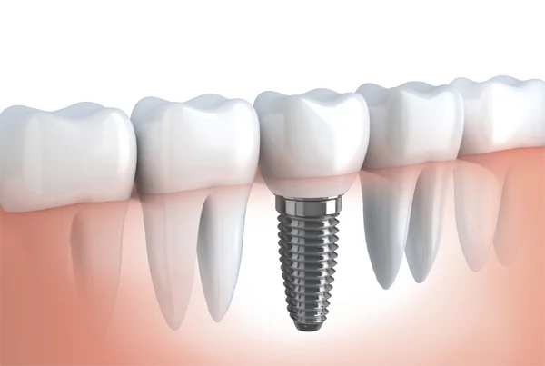 DENTAL IMPLANT