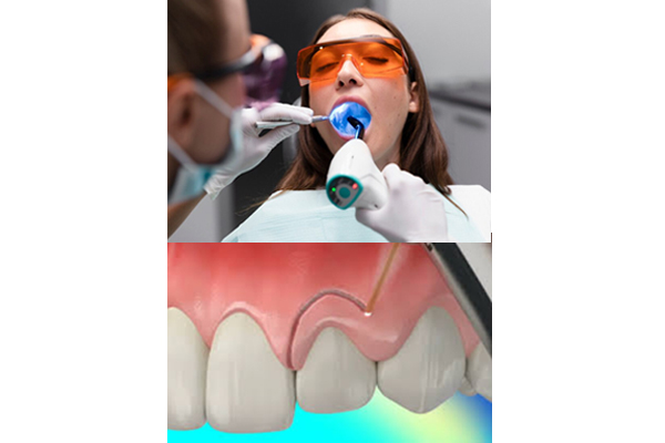 LASER DENTISTRY