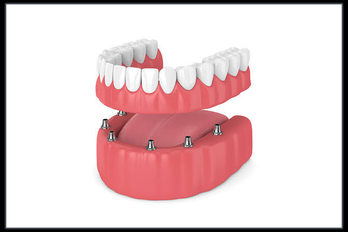 Dental Implant Full Mouth Denture